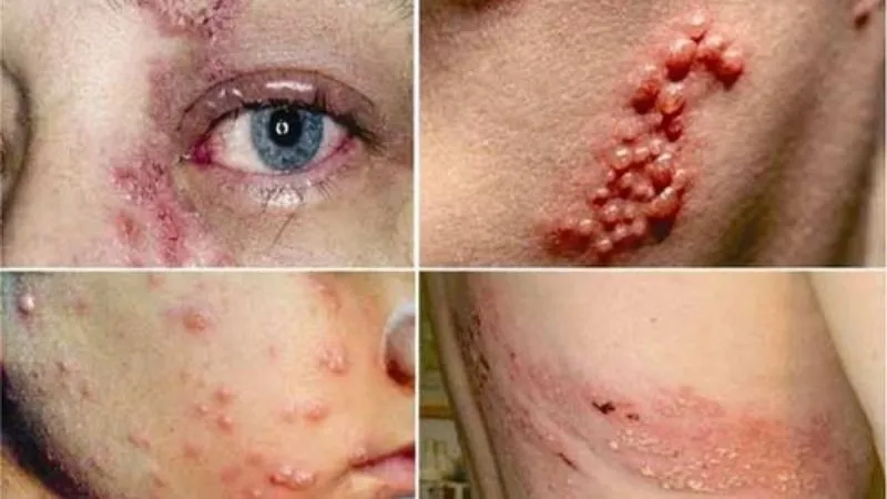 Các thể lâm sàng thường gặp của Zona thần kinh