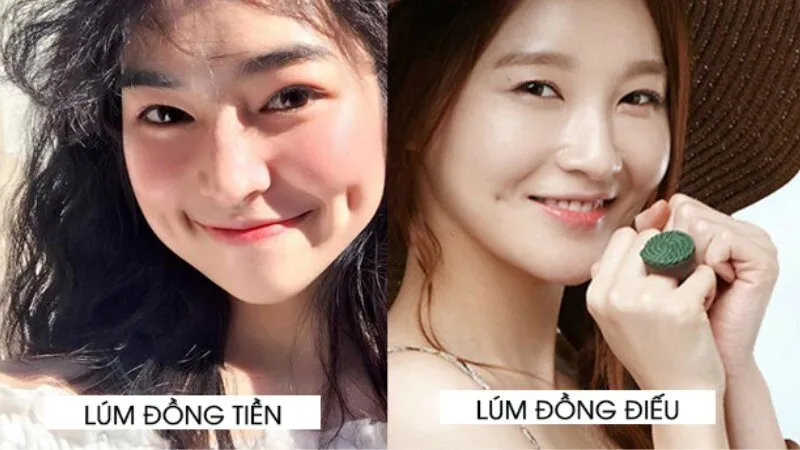Sự khác biệt giữa má lúm đồng tiền và lúm đồng điếu là gì?