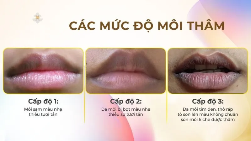 Dấu hiệu nhận biết các cấp độ thâm môi