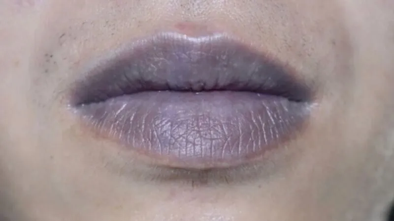 Hiểu rõ về tình trạng môi thâm là gì?