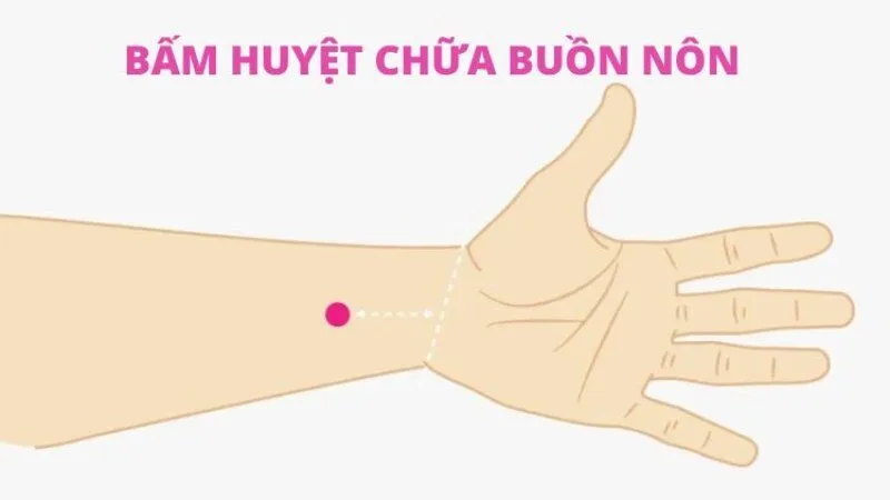 Phương pháp bấm huyệt giảm buồn nôn
